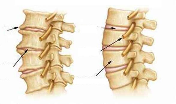 Was ist Osteochondrose