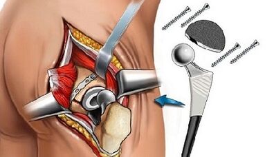 Endoprothisch für Hüftarthrose
