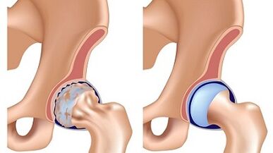 Symptome der Arthrose des Hüftgelenks