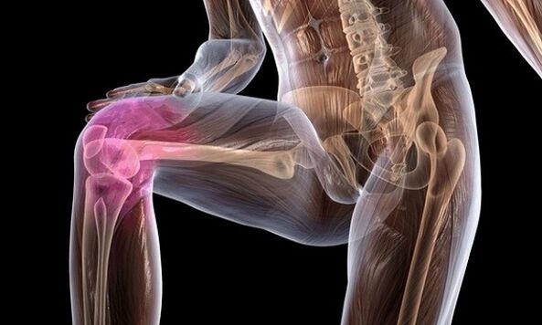 Anzeichen und Symptome einer Arthrose des Kniegelenks