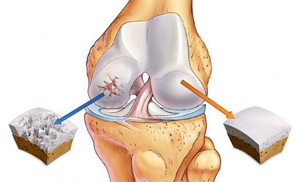 Norm und Abweichung für die Arthrose des Kniegelenks