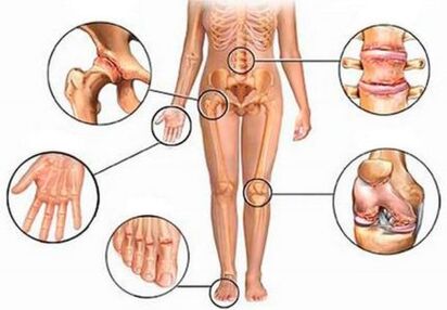 Arthritis und Arthrose verschiedener Gelenke