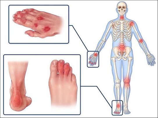 Hautrötung und Schwellung der Gelenke mit Arthritis